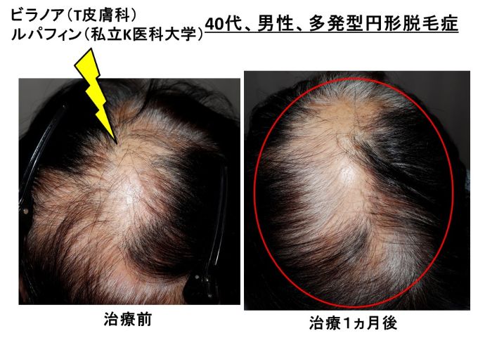 円形脱毛症　病院